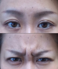 ボトックス眉間